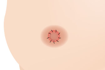 봉합