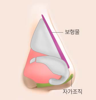 삽입