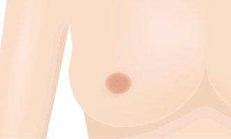 함물유두 3단계