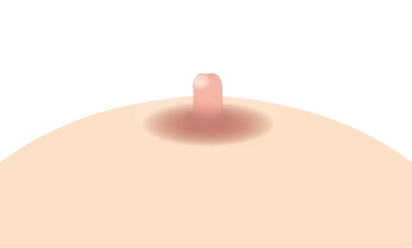 비정상적인 유두